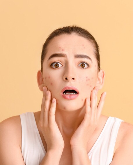 Antiandrógenos para Acné