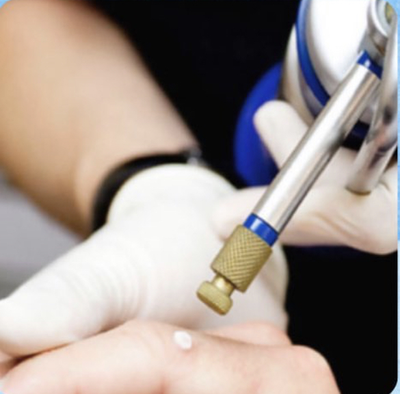 Crioterapia para Cicatrices