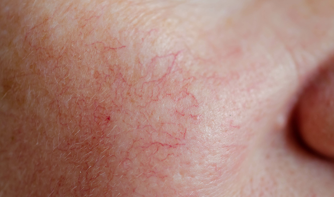 Rosácea - Casos clínicos